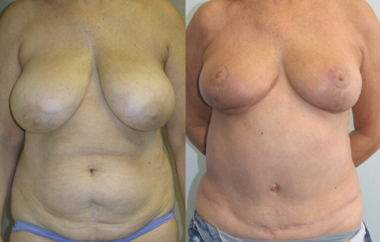 62-year-old-tummy-tuck-one-year-liposuction-back-breast-reduction-3-months-front