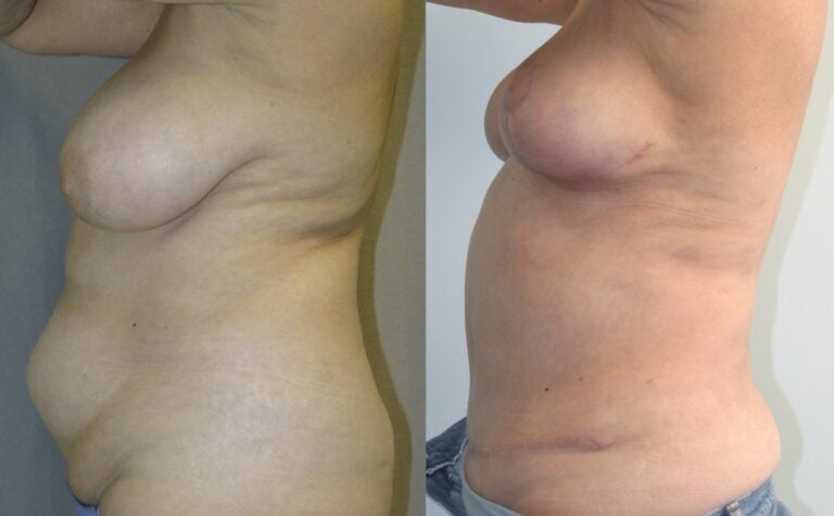 62-year-old-tummy-tuck-one-year-liposuction-back-breast-reduction-3-months-left-side