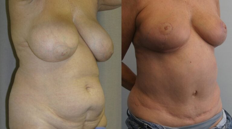 62-year-old-tummy-tuck-one-year-liposuction-back-breast-reduction-3-months-right-oblique