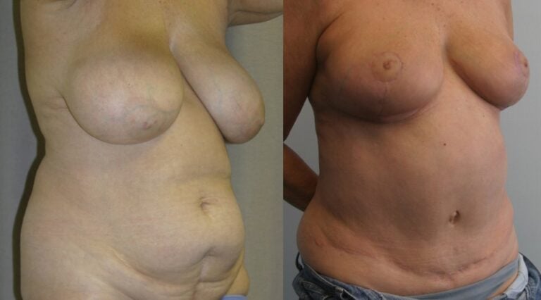 62-year-old-tummy-tuck-one-year-liposuction-back-breast-reduction-3-months-right-oblique
