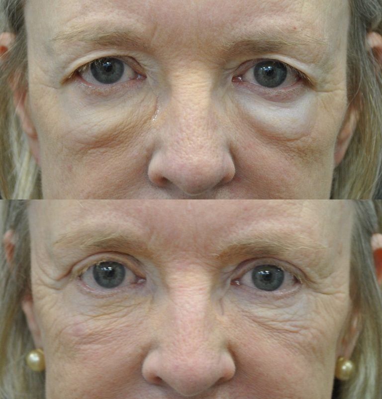 A 63-year-old patient looks more relaxed and refreshed six months after her upper and lower blepharoplasty. Her forward gaze is seen here. 