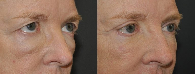 The same patient in an oblique forward gaze
