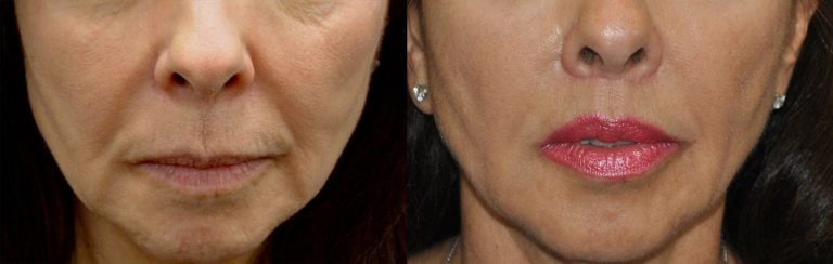 63 year-old patient, lip lift and fat injections to lips - 1