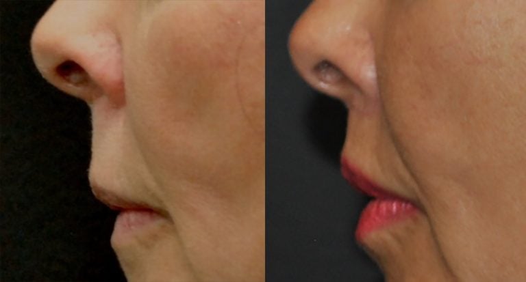 63 year-old patient, lip lift and fat injections to lips - 2
