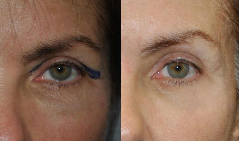 A 64-year-old patient five months after upper blepharoplasty, six weeks after transconjunctival lower blepharoplasty with filler removal, and 30 percent TCA peel on the left eye 