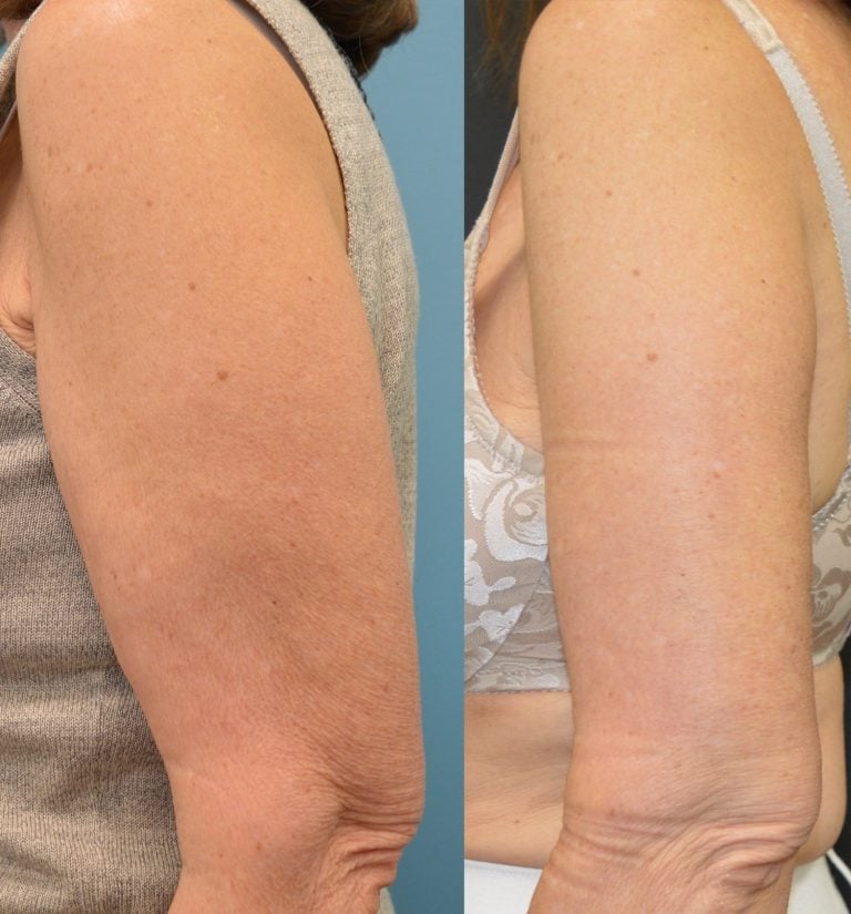 65-year-old-brachioplasty. Arms-at-side-left-side-view-one-month