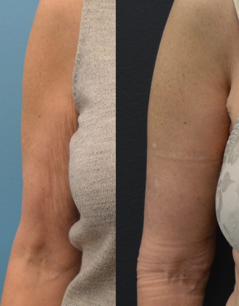 65-year-old-brachioplasty. Arms-at-side-one-month