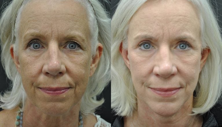 68-year-old-one-year-after-facelift-submental-platysmaplasty-chin-implant-upper-blepharoplasty-lower-eyelid-TCA-peel-front