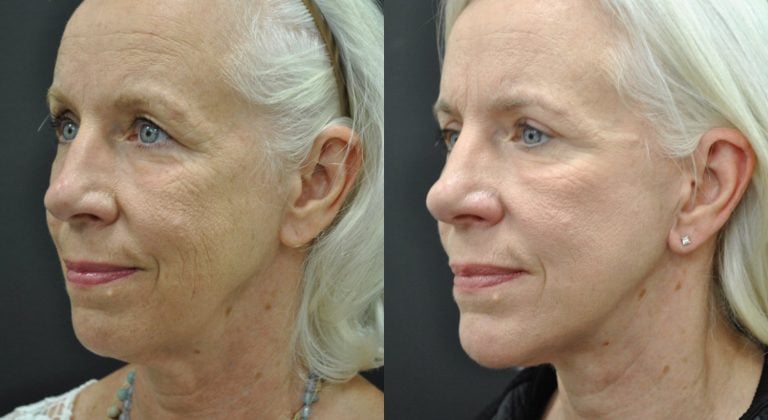 68-year-old-one-year-after-facelift-submental-platysmaplasty-chin-implant-upper-blepharoplasty-lower-eyelid-TCA-peel-oblique.