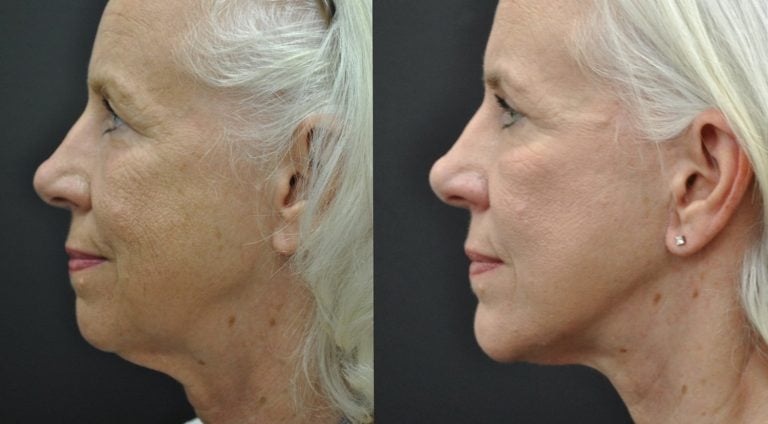 68-year-old-one-year-after-facelift-submental-platysmaplasty-chin-implant-upper-blepharoplasty-lower-eyelid-TCA-peel-side