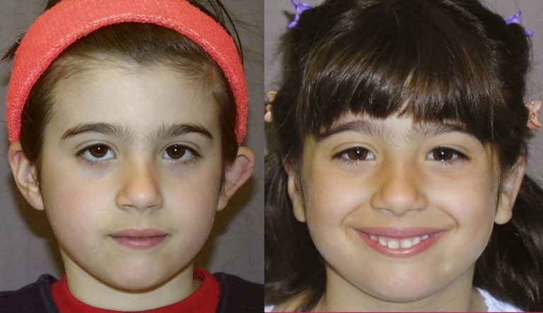 7-year-old female bilateral otoplasty, right ear