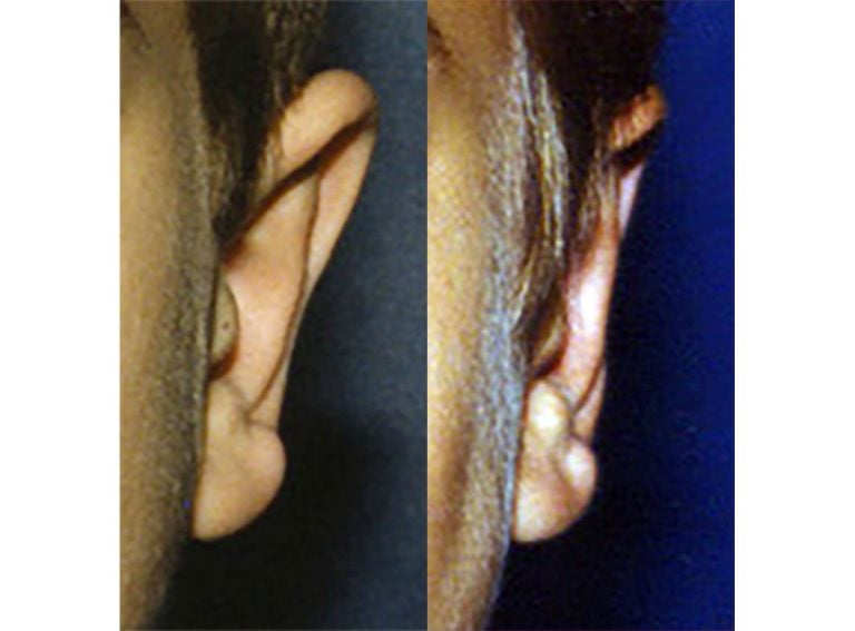 7-year-old male bilateral otoplasty, left ear