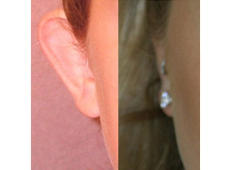 13-year-old female bilateral otoplasty, six years, right ear
