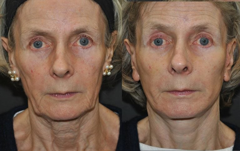70-year-old-one-month-after-neck-lift-and-jawline-lift-front