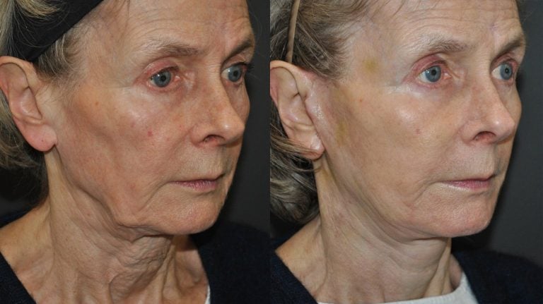 70-year-old-one-month-after-neck-lift-and-jawline-lift-oblique-right