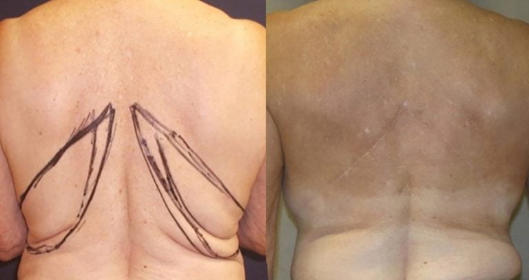 74-year-old female after flank lift, 2 years