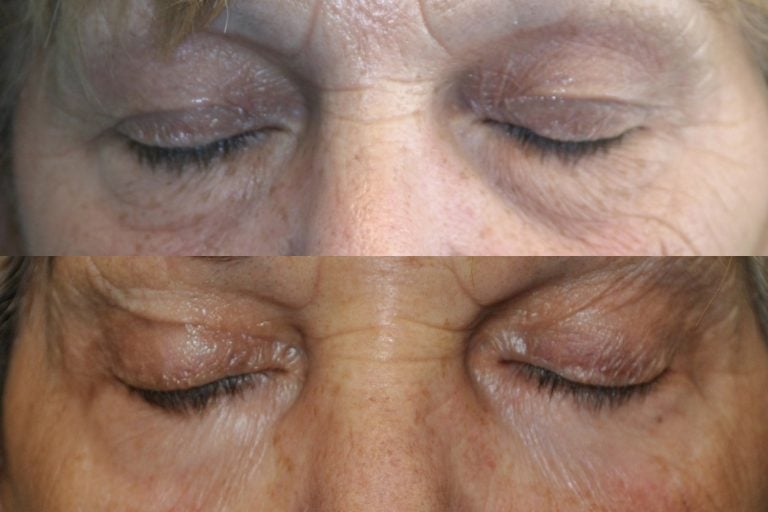 The same patient with closed eyes