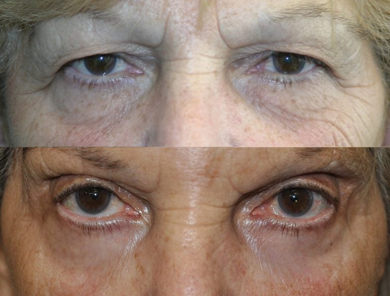 A 76-year-old patient ten years after upper and lower blepharoplasty with peel on the lower eyelids. This view shows the eyes open.