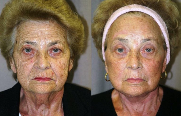 76-year-old-facelift-brow-lift-upper-and-lower-eye-lift-one-year-follow-up