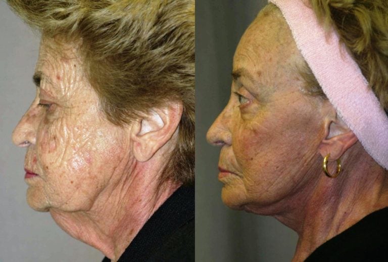 76-year-old-facelift-brow-lift-upper-and-lower-eye-lift-one-year-follow-up-lateral