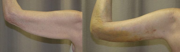 77-year-old-brachioplasty-8-days-left-arm-back