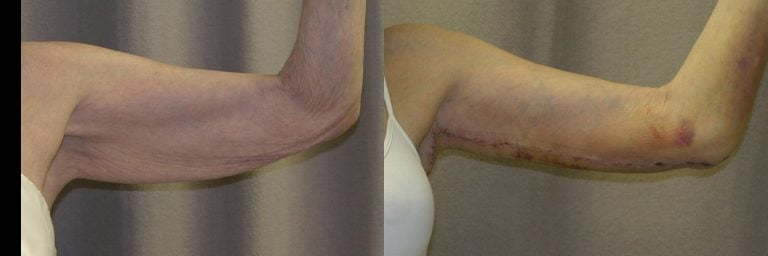 77-year-old brachioplasty 8 days left arm front