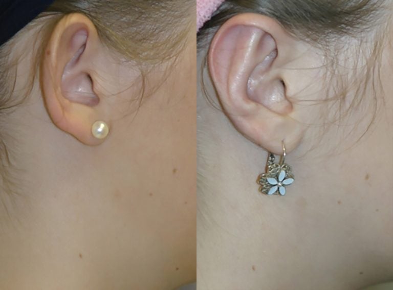 14-year-old female bilateral otoplasty, five months, right ear, side