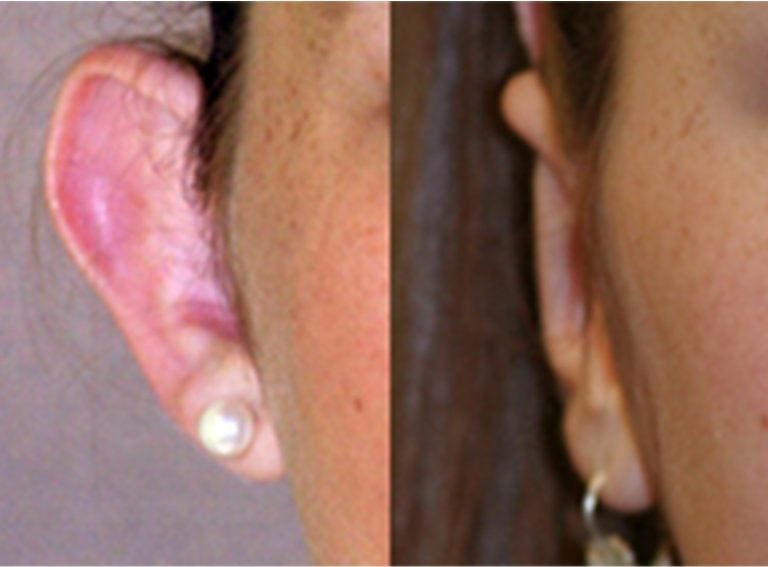 14-year-old female bilateral otoplasty, five months, right ear