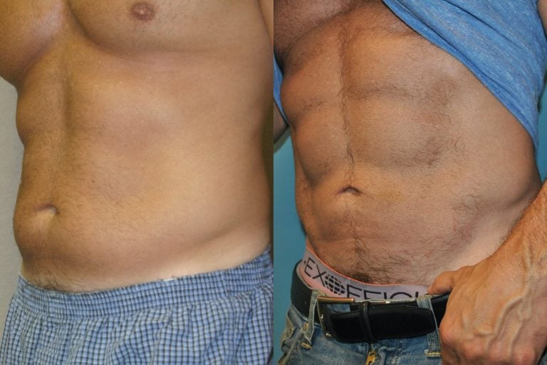 Abdominal etching liposuction abdomen