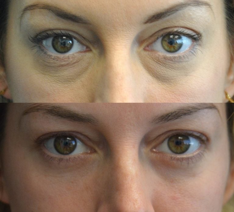 This patient looks younger and more alert after her transconjunctival blepharoplasty procedure with lower eyelids peel.