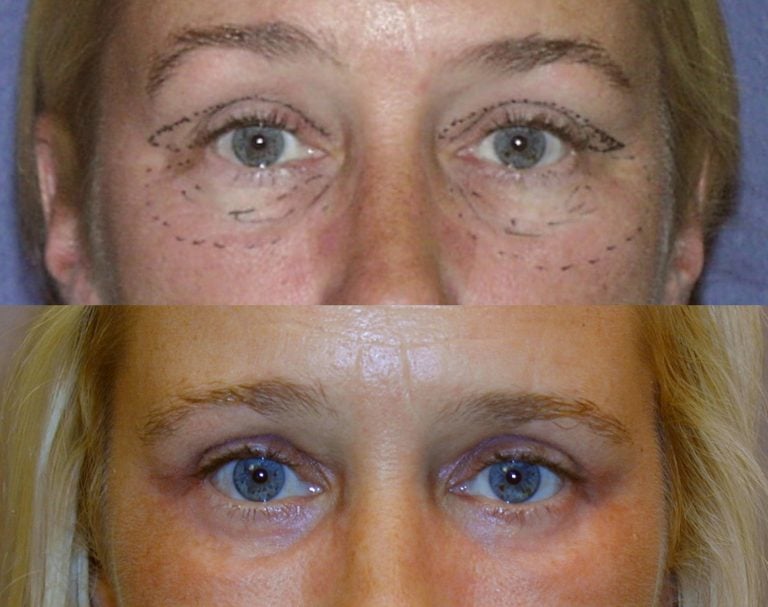 This patient looks more appealing after her upper and lower transconjunctival blepharoplasty procedure with lower lids peel. 