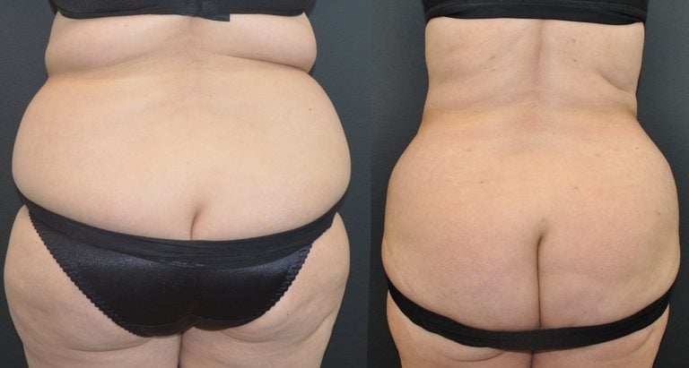58-year-old, 5’0” 150 lbs initially. BMI 29.3 preop 25.5 postop, 20 lb weight loss. Initial surgery: 1250 ml liposuction / 1541 gm excision lower abdomen. 8 months after abdominoplasty; Liposuction of upper abdomen and bilateral hips, flanks, and back. 5 months after flanks, sides of breasts and fat injections to buttocks, Bodytite to flanks.