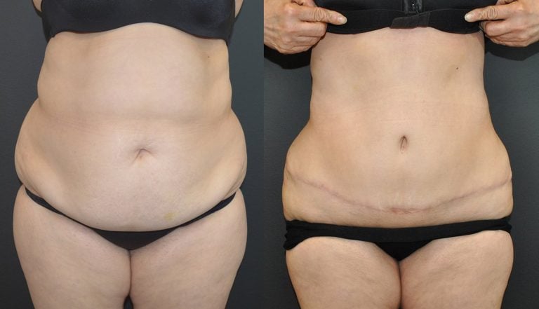 58-year-old, 5’0” 150 lbs initially. BMI 29.3 preop 25.5 postop, 20 lb weight loss. Initial surgery: 1250 ml liposuction / 1541 gm excision lower abdomen. 8 months after abdominoplasty; Liposuction of upper abdomen and bilateral hips, flanks, and back. 5 months after flanks, sides of breasts and fat injections to buttocks, Bodytite to flanks.