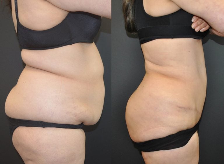 58-year-old, 5’0” 150 lbs initially. BMI 29.3 preop 25.5 postop, 20 lb weight loss. Initial surgery: 1250 ml liposuction / 1541 gm excision lower abdomen. 8 months after abdominoplasty; Liposuction of upper abdomen and bilateral hips, flanks, and back. 5 months after flanks, sides of breasts and fat injections to buttocks, Bodytite to flanks.