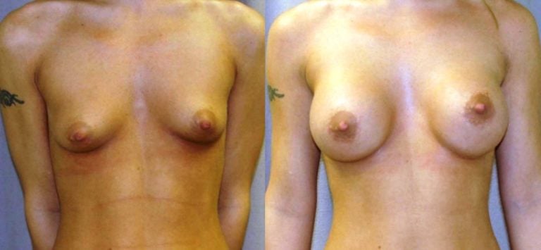 breast augmentation 300 cc saline spectrum front view