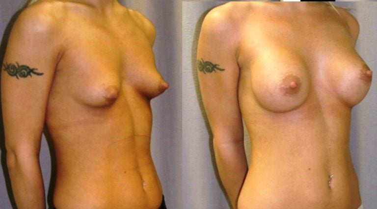 breast augmentation 300 cc saline spectrum oblique view