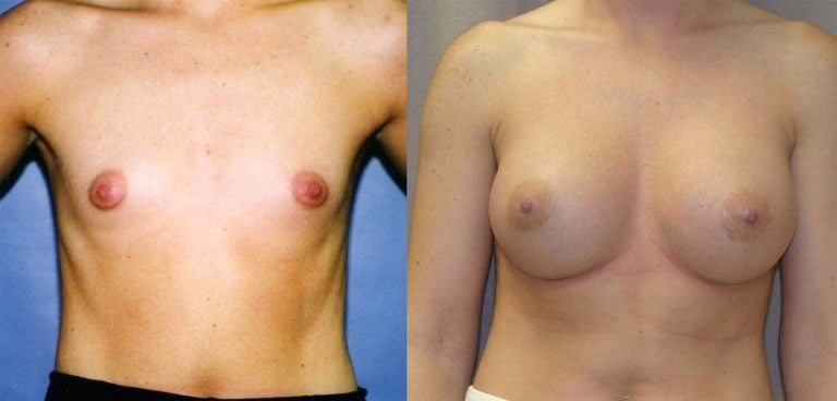 Breast augmentation 450 cc style 20 silicone gel one year follow up frontal view