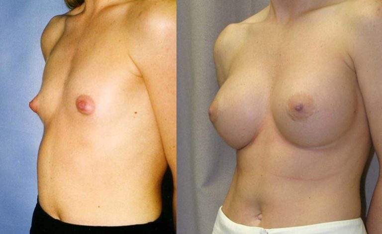 breast augmentation 450 cc style 20 silicone gel one year follow up oblique view