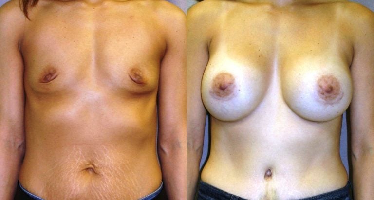 breast augmentation front