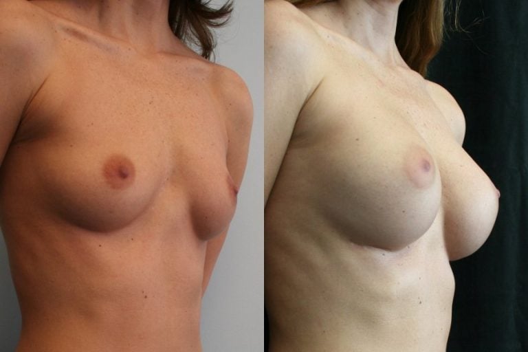 Breast Augmentation Mammaplasty (BAM) 5 years after surgery infra-mammary crease incision right oblique view