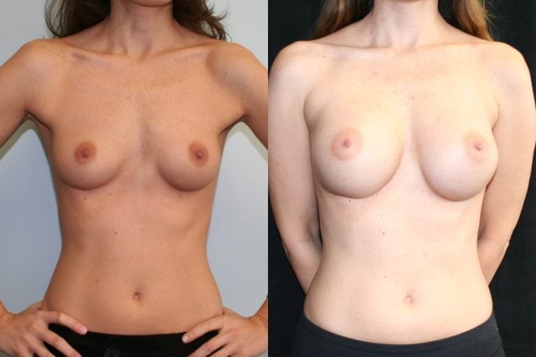 Breast Augmentation Mammaplasty (BAM) infra-mammary crease incision front view