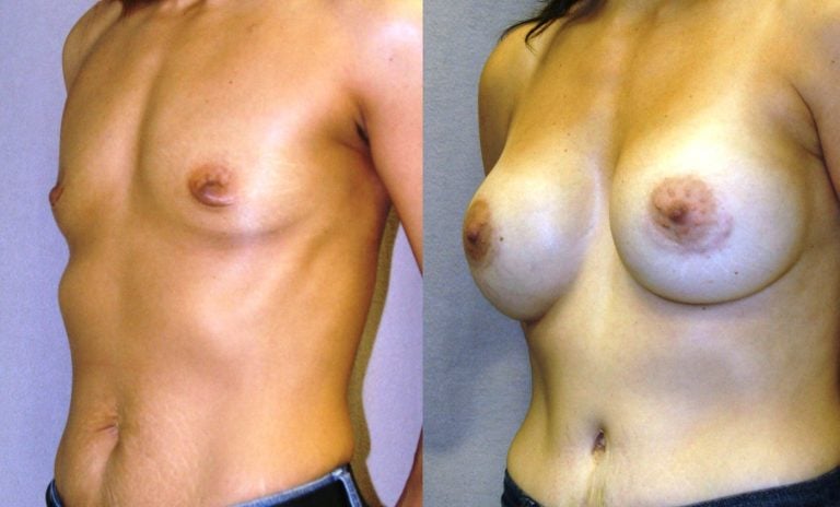 Breast augmentation oblique