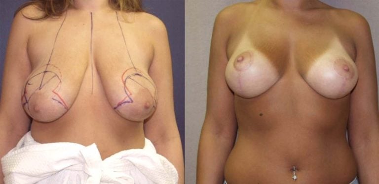 Breast-Autoaugmentation-patient-1-front-view