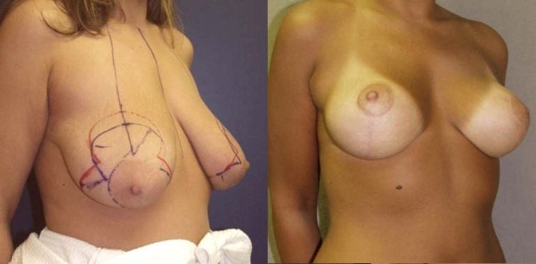 Breast-Autoaugmentation-patient-1-oblique-view