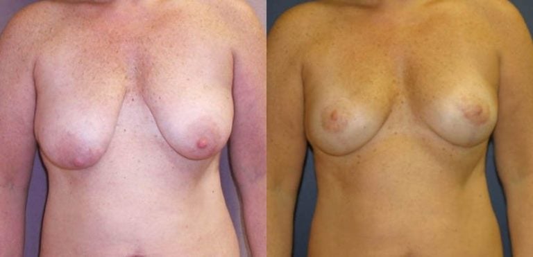 Breast-Auto augmentation-Patient-3-front-view