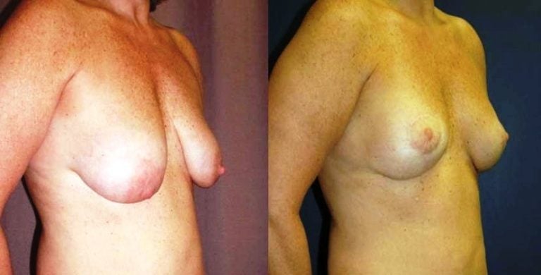 Breast-Auto augmentation-patient-3-oblique
