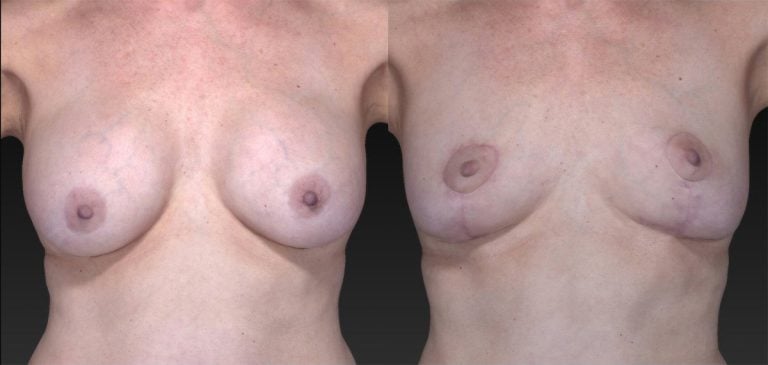 61-year-old 12 years after breast augmentation three months after removal of implants, breast auto-augmentation™ & fat injection, front