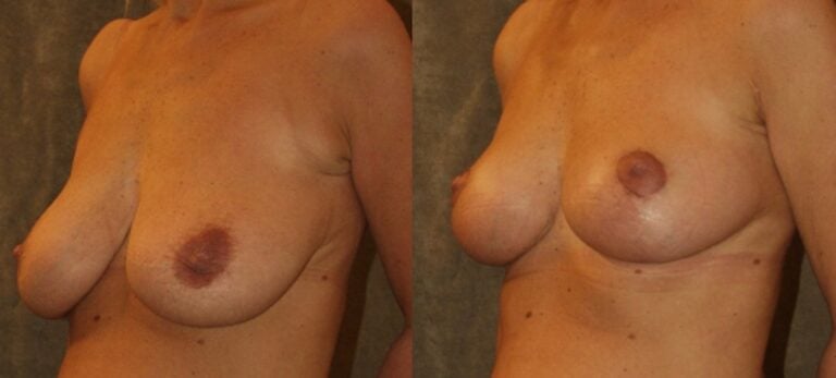 breast-red-axillaplasty-obl