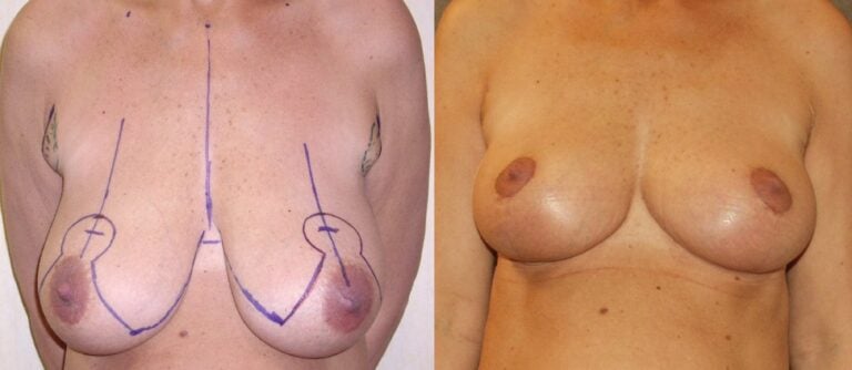 breast-red-axillaplasty-preop-markings