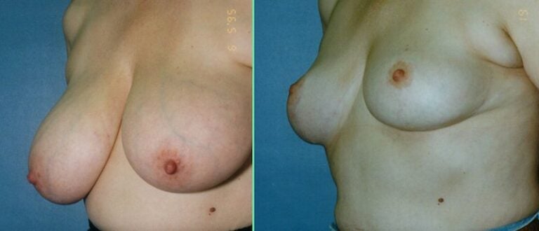 Breast-reduction-oblique